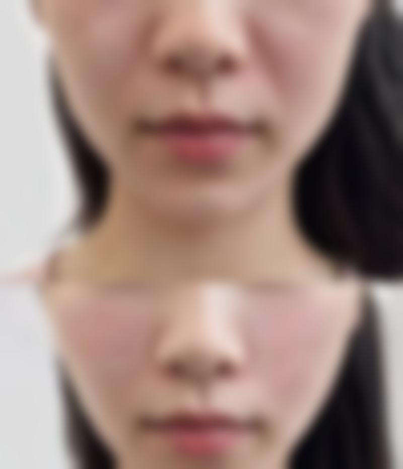 全身美白针有效吗？权威数据揭示70%使用者显著美白，揭秘美白针背后的科学原理与惊人效果！ 