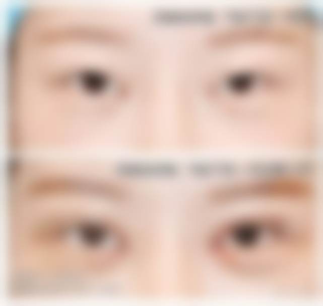 北京市张冰洁的眼部修复术后修复怎么样