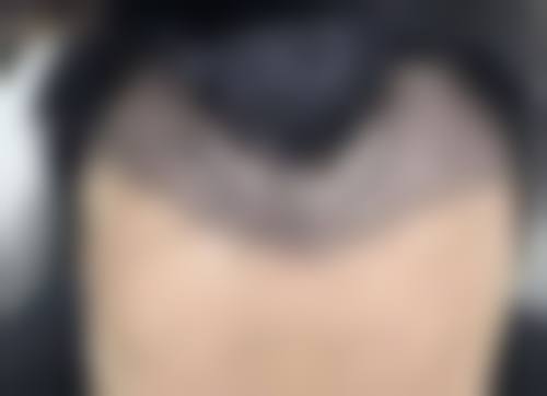 打了瘦脸针除皱针几天可以化妆