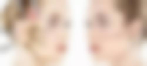 除皱瘦脸针后要注意什么事项