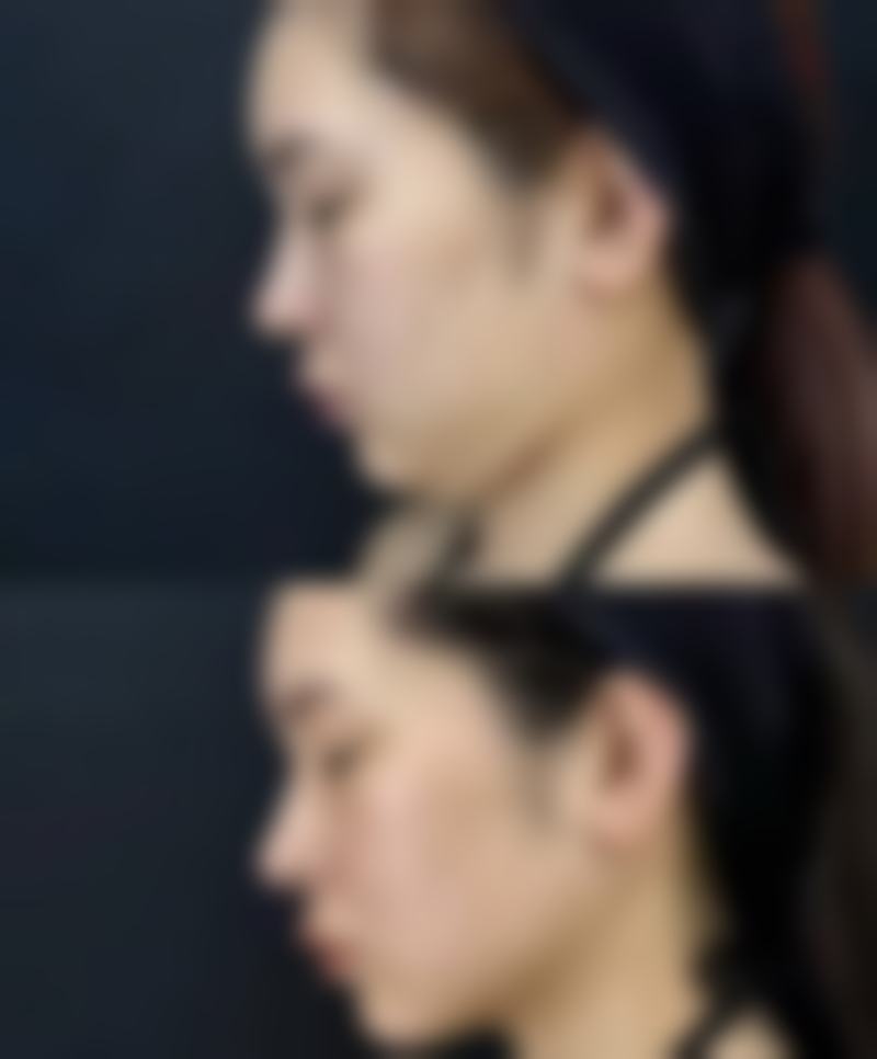 黄盖美白针vs白盖美白针