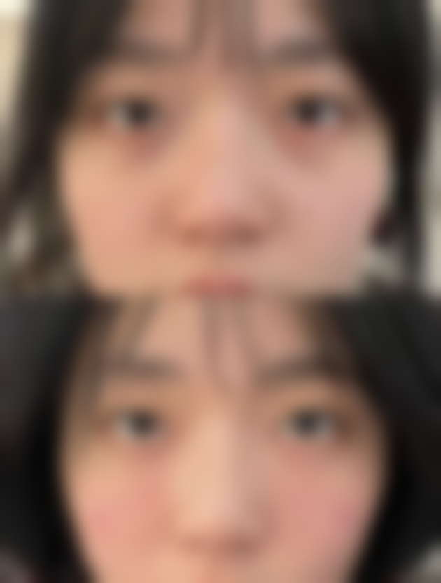 打了瘦脸针脸变大了是怎么回事啊