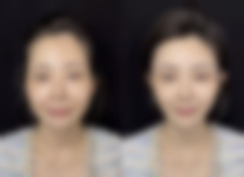 注射完瘦脸针之后多久可以洗脸化妆