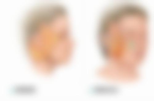 童颜针丰太阳穴好吗有成效吗