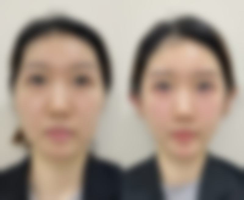 皮秒除皱成效怎么样知乎