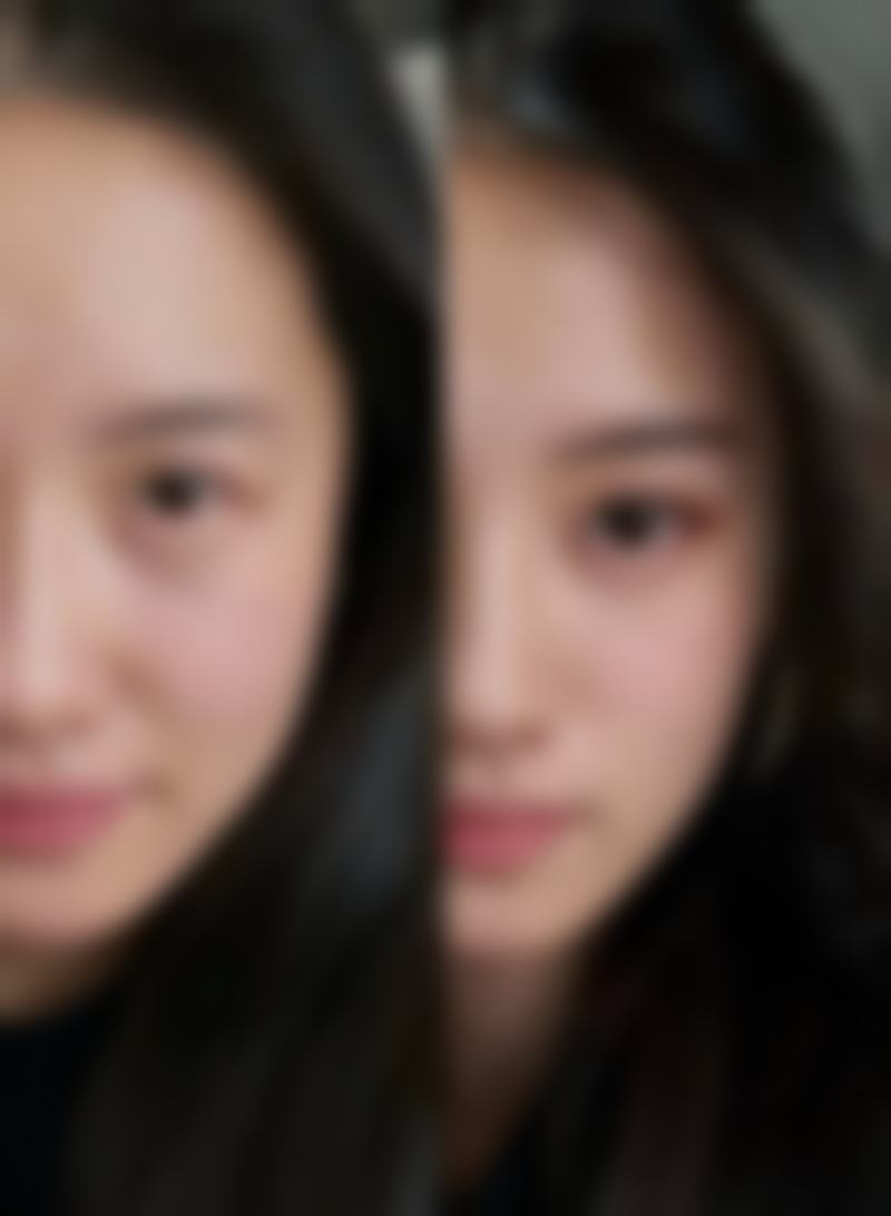皮秒去皱有成效吗
