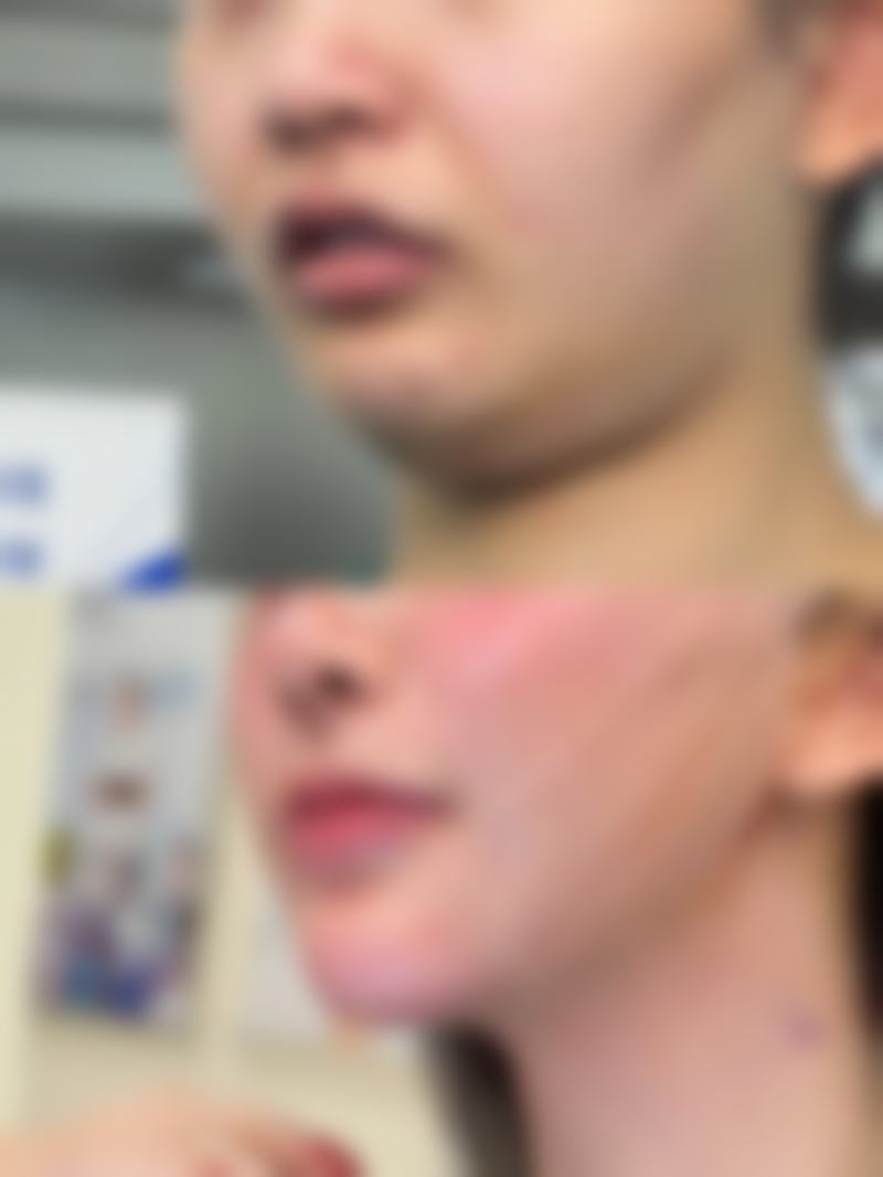 打完除皱针脸部僵硬怎么缓解