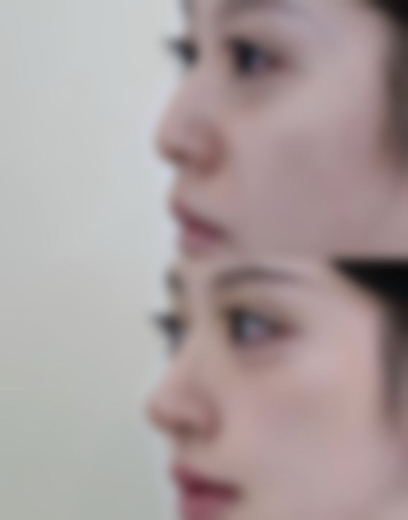 14岁可以打瘦腿针吗