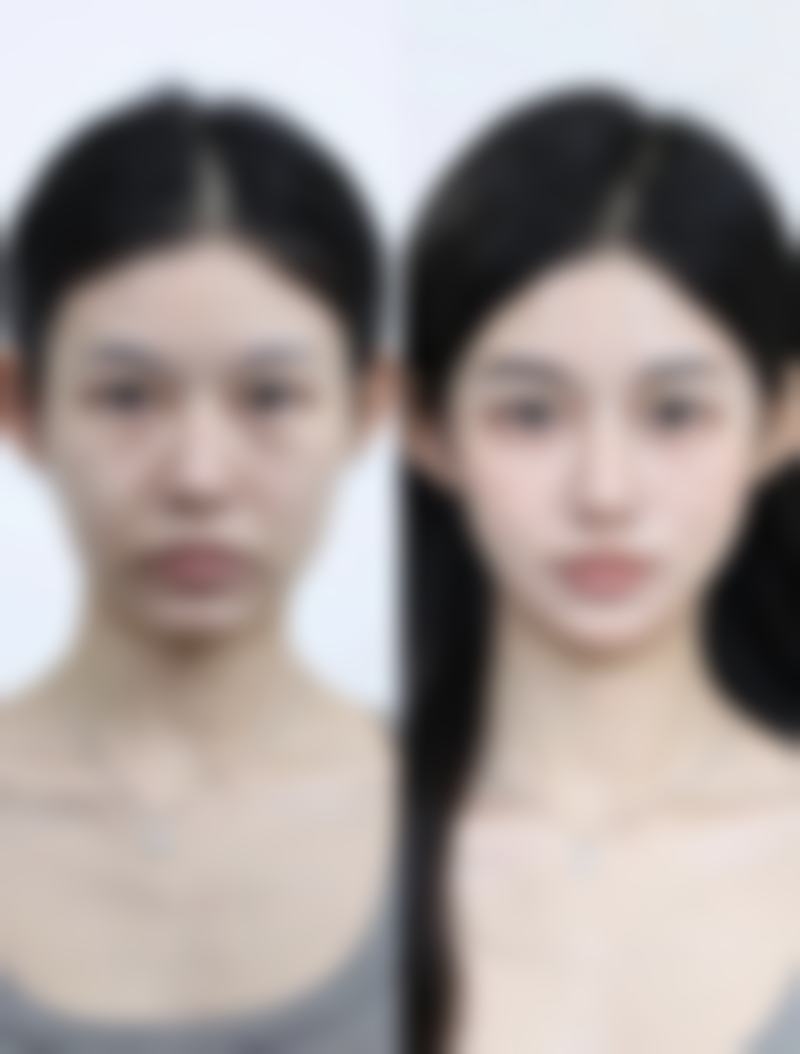 阴道紧缩术对怀孕的影响