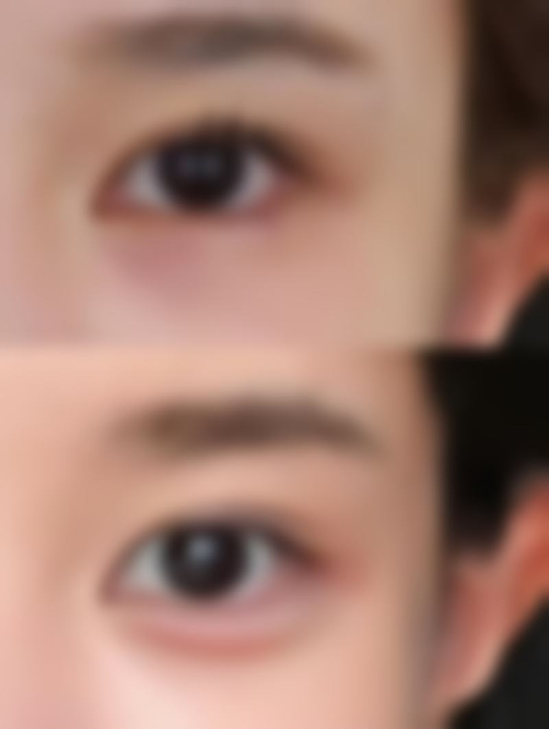 打瘦脸针蛙腮多久能消?