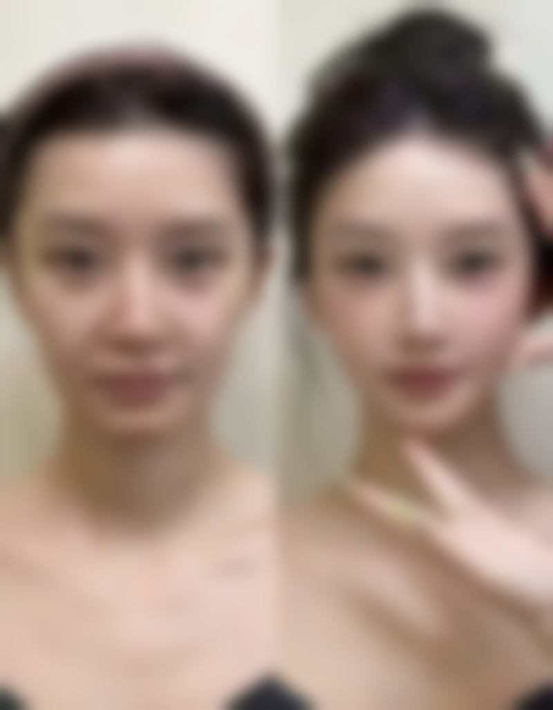 瘦脸针间隔多久打一次更好