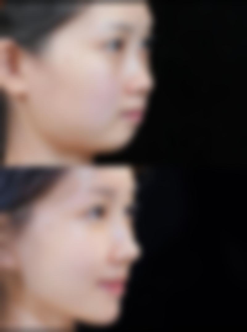 打除皱针怎样能消除眼袋