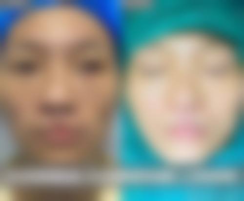 临床实例分享:佳木斯美白医疗美容医院姚颖