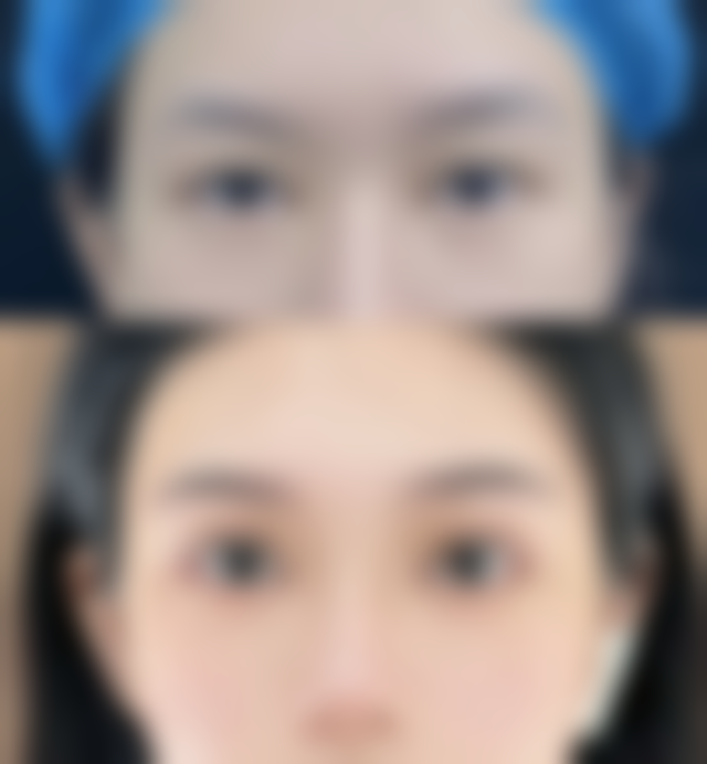 瘦脸针打一次维持多久