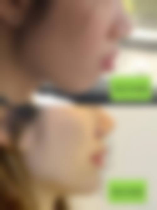 临床实例分享温州鹿城口腔医院段兴效