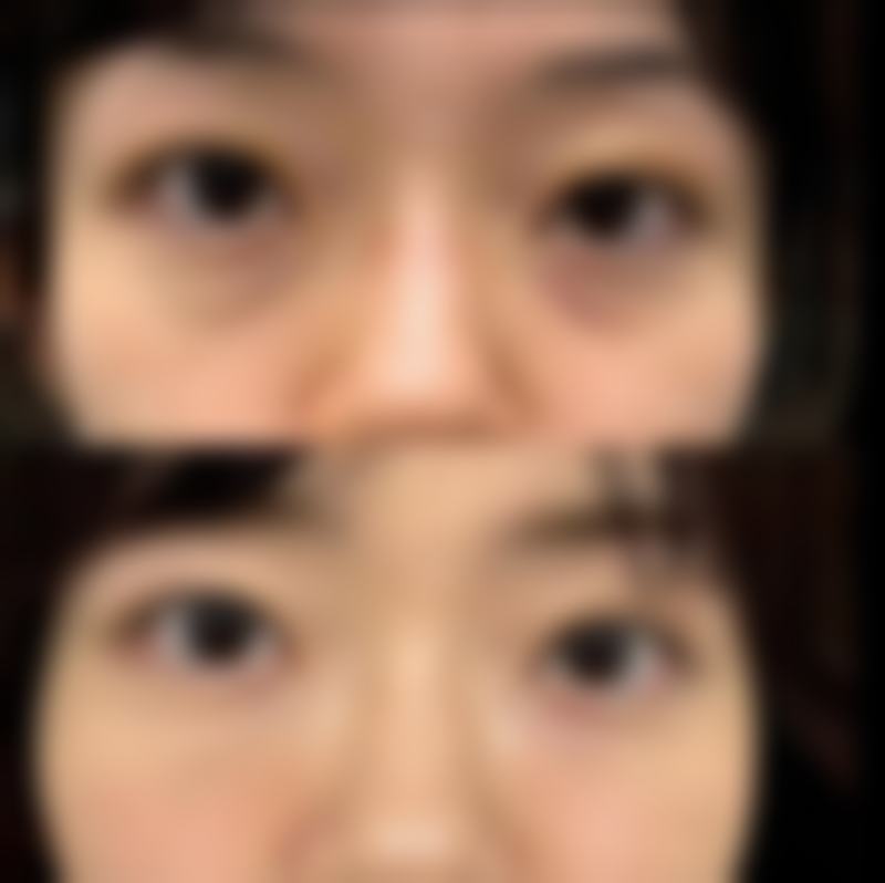 瘦脸针术后其他需要注意的护理细节