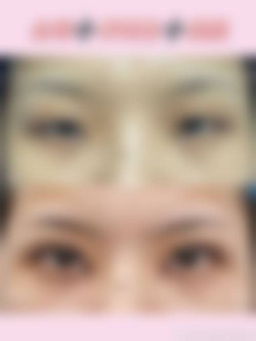 什么是韩国小切口拉皮?它和普通拉皮有什么区别?