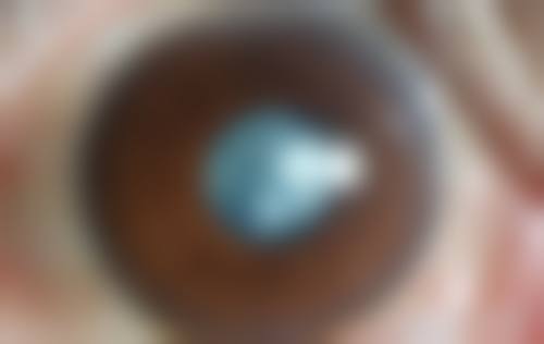 擅长项目详解:近视与白内障诊疗