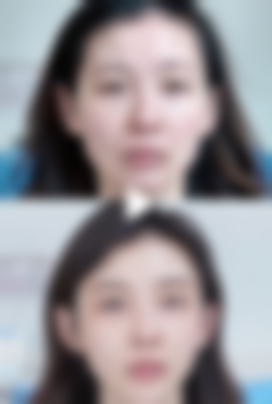 热玛吉全脸包括眼部吗？怎么选适合自己的套餐