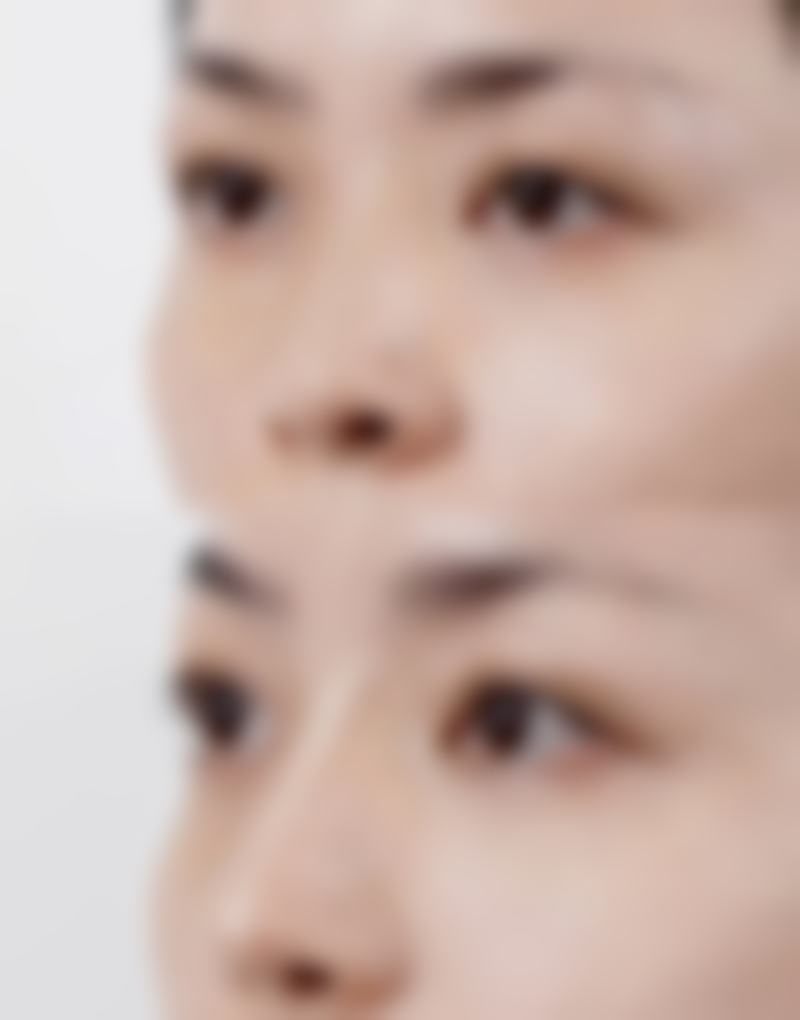 矫正前需要了解的几个注意事项