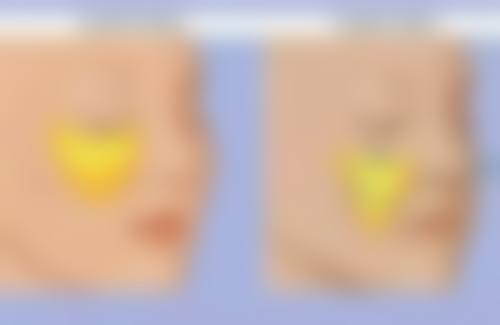 打瘦脸针需要注意什么?术前术后全指南