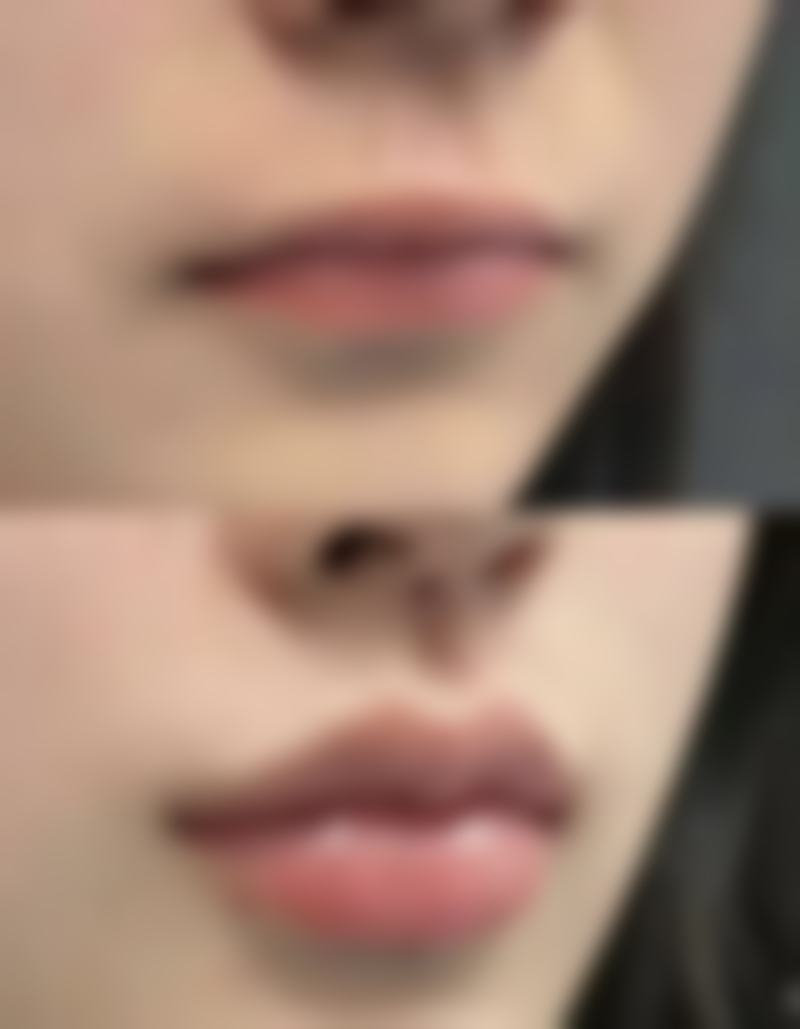 打美白针有什么副作用或者后遗症?长期注射的风险整理