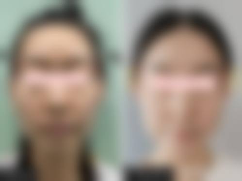 临床实例分享:石家庄壹零壹华擎医疗美容医院唐丽金医生真实反馈