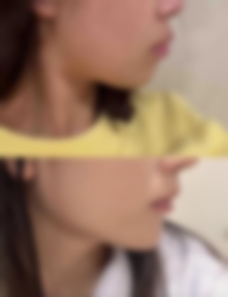 种植发际线需要多少钱?不同技术收费明细