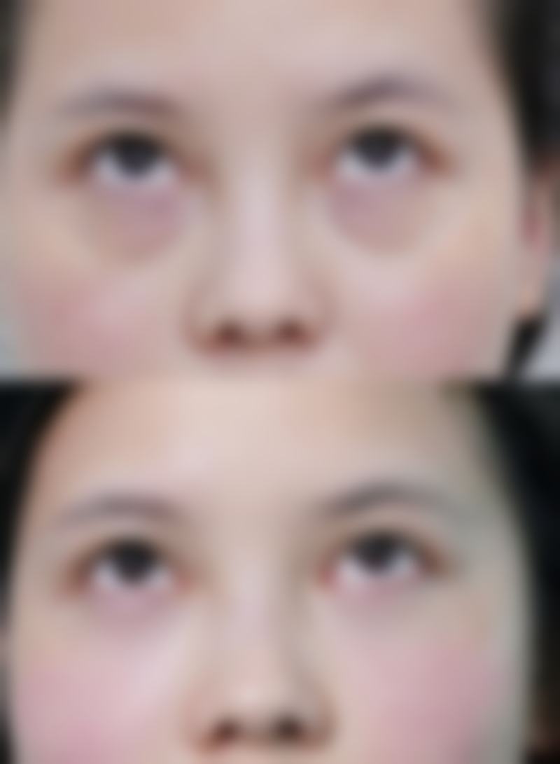 瘦脸针的危害和副作用相关说明