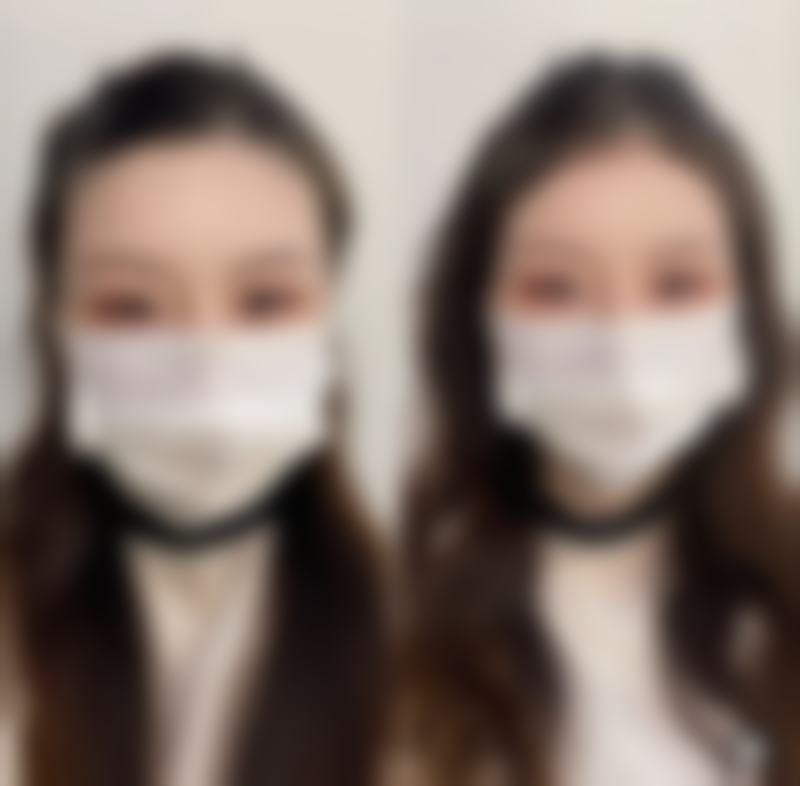 打了瘦脸针之后不同阶段的变化参考