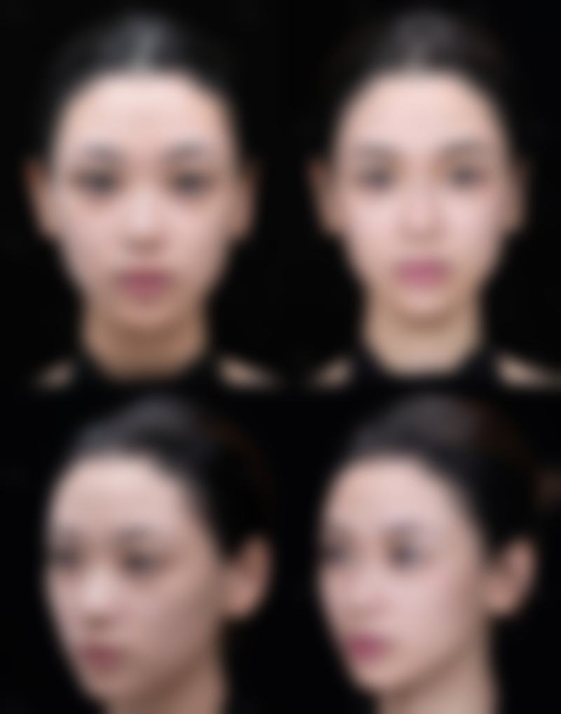 临床实例分享:肖旭远+南京新帝瑞拉整形医院+核心项目