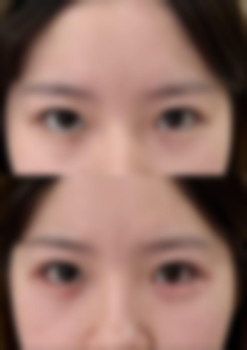 刚打完瘦脸针脸更大了是什么原因？