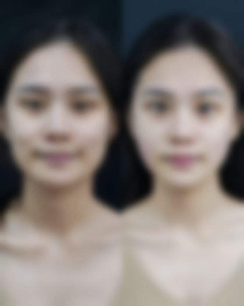 嘴唇改薄是恒久的吗?术后会不会出现反弹变厚的情况?
