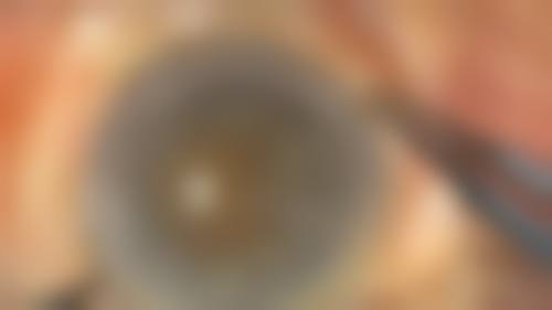 诊疗特色总结:刁鹏飞+南京医 科 大学附属逸夫医院眼科