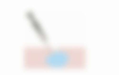 瘦脸针打了多久成效更明显?峰值期的状态说明